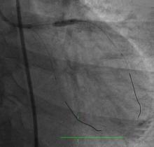 Rotablating the Un-dialatable Lesions