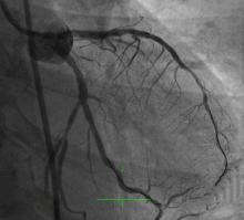 Rotablating the Un-dialatable Lesions