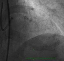 Rotablating the Un-dialatable Lesions