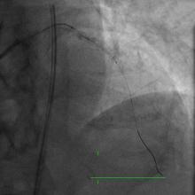 Rotablating the Un-dialatable Lesions