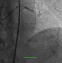 Rotablating the Un-dialatable Lesions