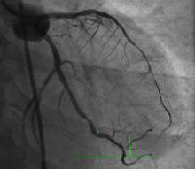 Rotablating the Un-dialatable Lesions