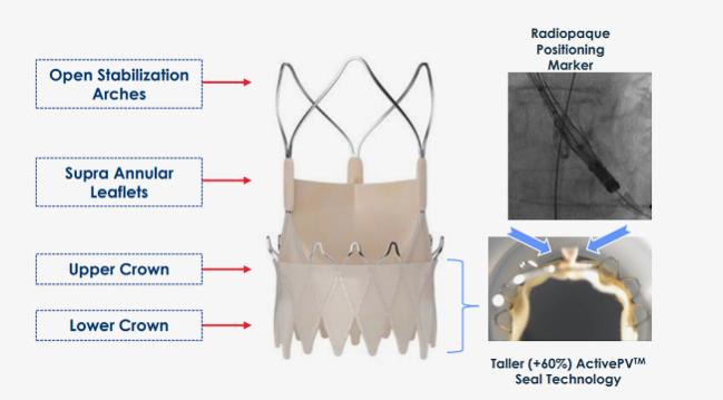 Less Paravalvular Leak With Newer Acurate neo2 TAVI: Registry 