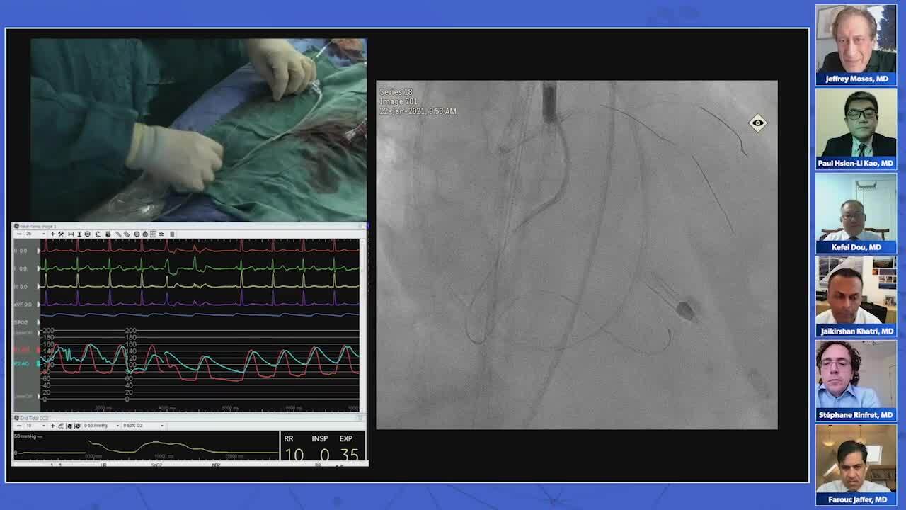 Session VIII: Live Cases — Calcified RCA and LAD CTO  (Emory University Medical Center)