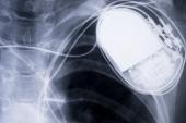 More HF, Worse Long-term Outcomes in TAVI Patients Who Get Pacemakers