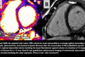 More Evidence Links Myocarditis to mRNA COVID-19 Vaccines 