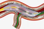 FDA Approves Shockwave Intravascular Lithotripsy for Calcified Coronaries