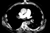 Interventional Options and Future Directions for Acute PE: New AHA Statement 