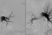 Hints of Benefit With Catheter-Directed Thrombolysis in Intermediate/High-Risk PE