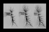 EXTRACT-PE: Positive Results With Aspiration Thrombectomy for Submassive PE