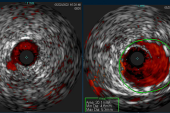 IVUS in Complex PCI Improves Outcomes, Even for Less-Experienced Operators